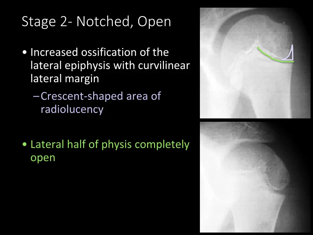 stage 2 notched open
