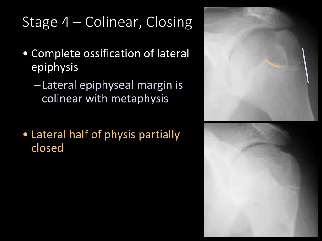 stage 4 colinear closing