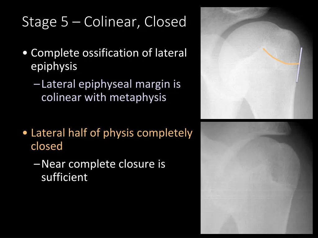 stage 5 colinear closed