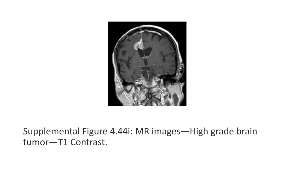 supplemental figure 4 44i mr images high grade