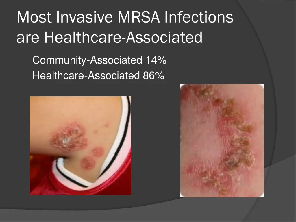 most invasive mrsa infections are healthcare