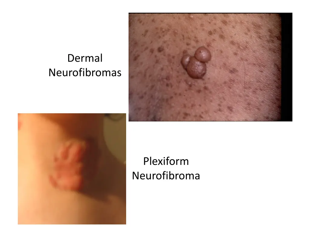 dermal neurofibromas