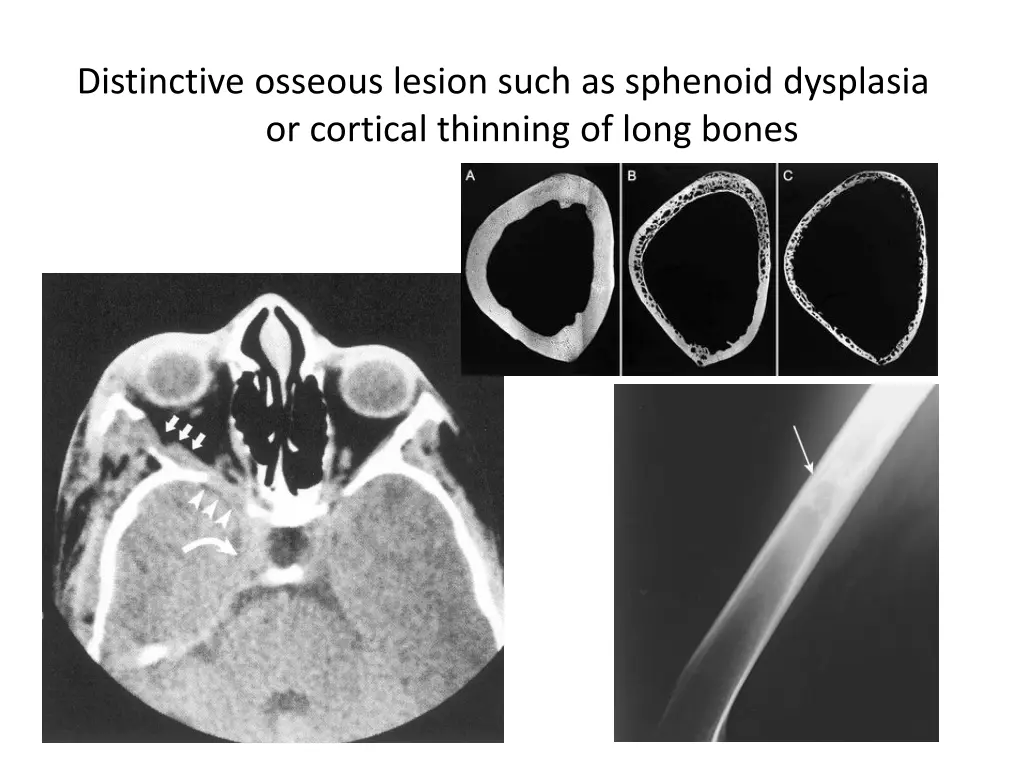 distinctive osseous lesion such as sphenoid
