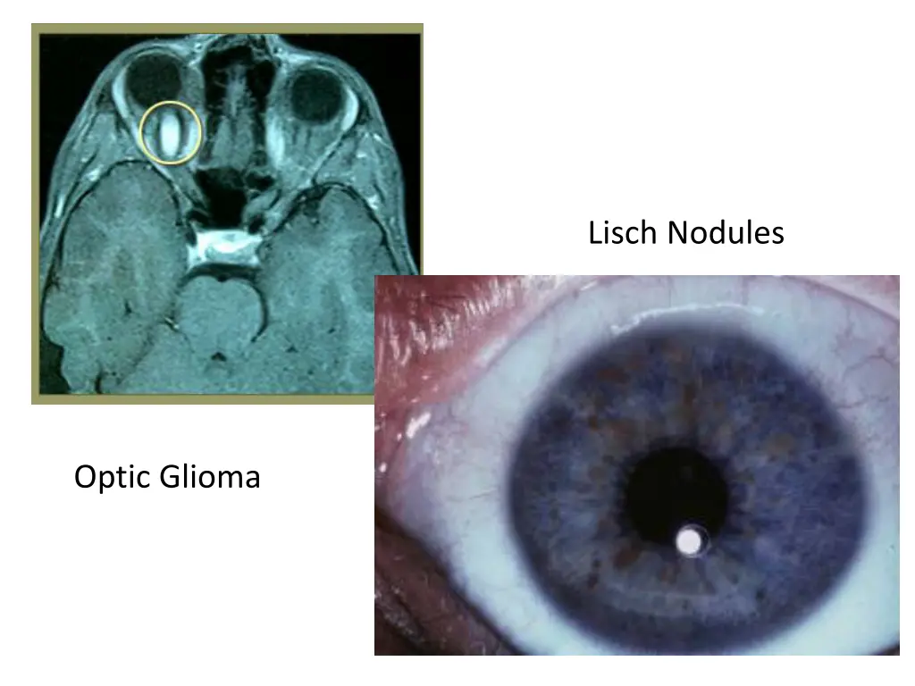 lisch nodules