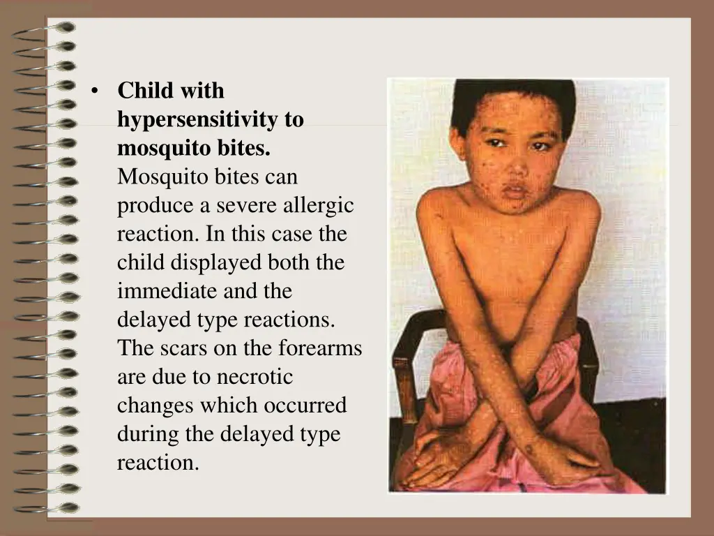 child with hypersensitivity to mosquito bites