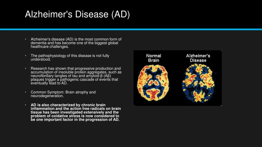 alzheimer s disease ad