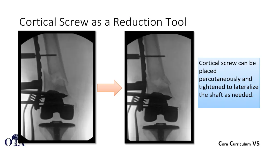 cortical screw as a reduction tool