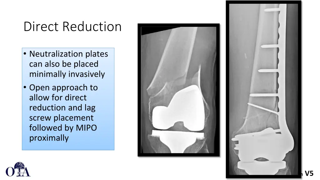 direct reduction