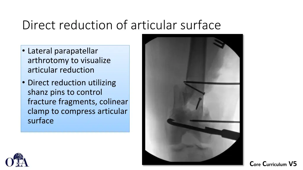 direct reduction of articular surface