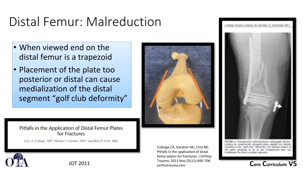 distal femur malreduction 1