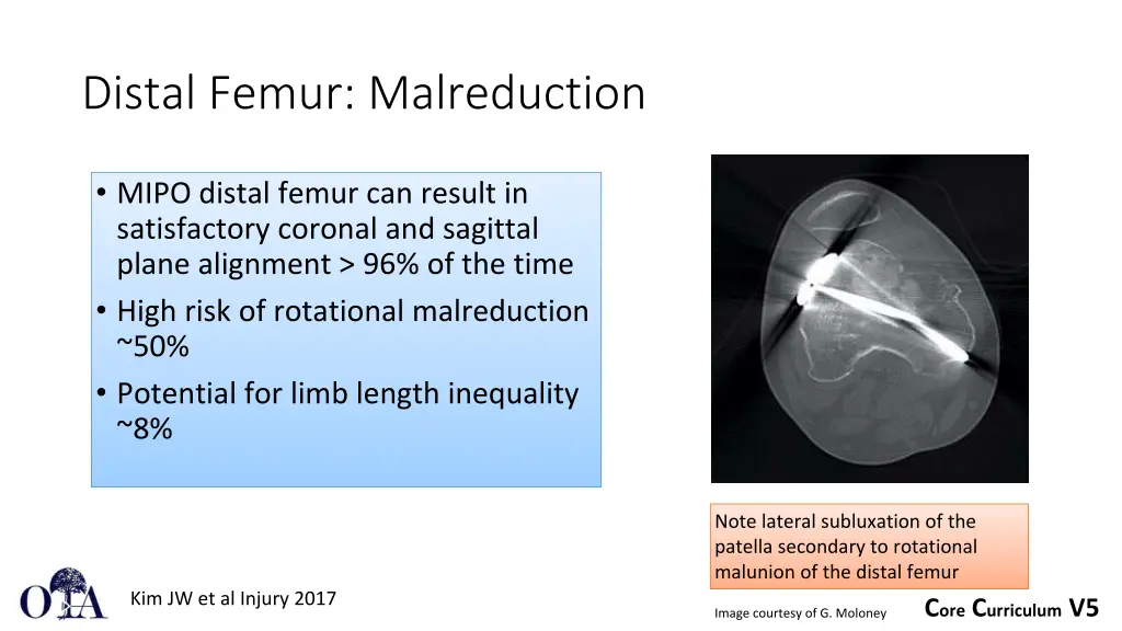 distal femur malreduction