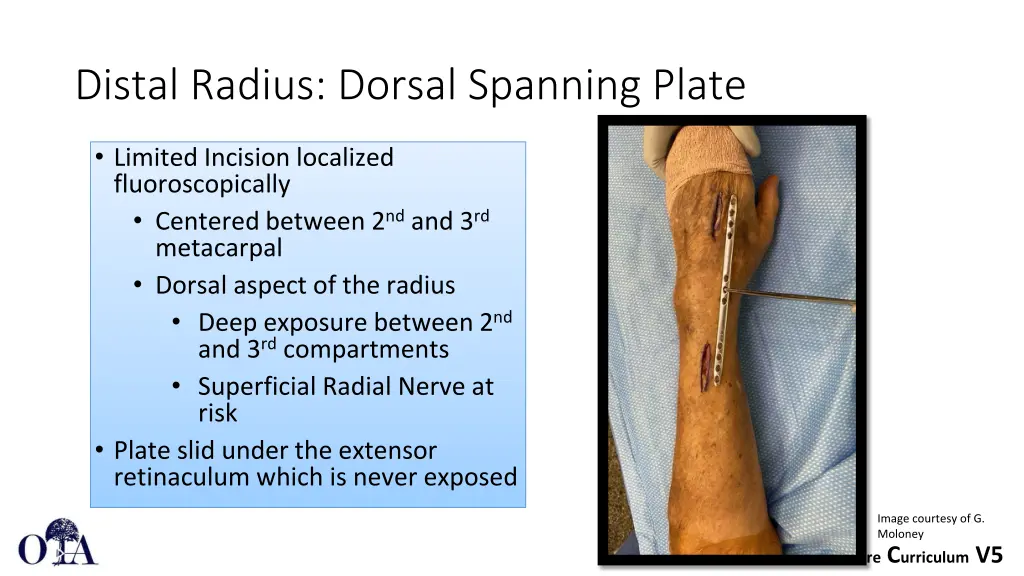 distal radius dorsal spanning plate 1