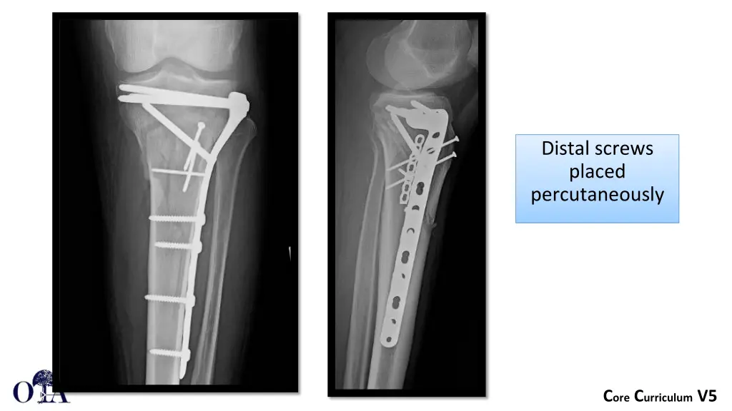 distal screws placed percutaneously