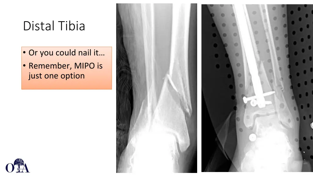 distal tibia 1