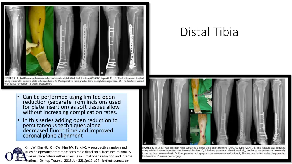 distal tibia