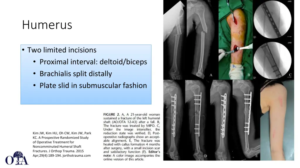 humerus 1