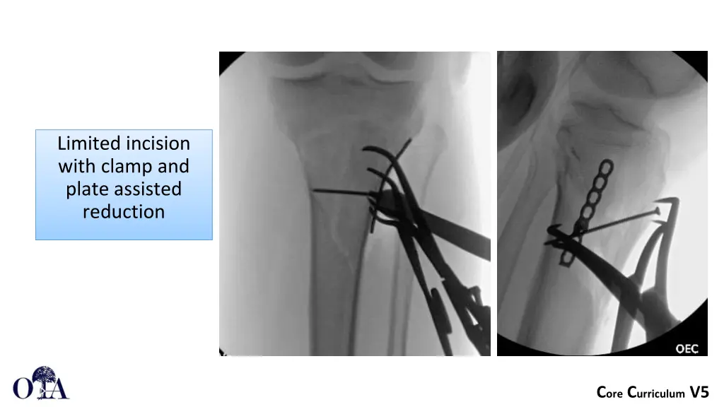 limited incision with clamp and plate assisted