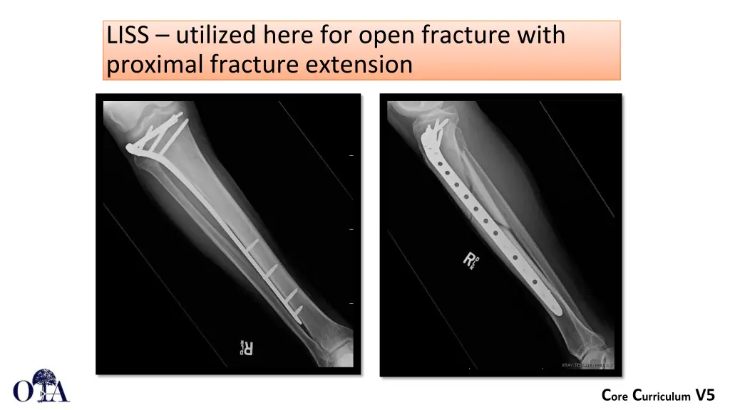 liss utilized here for open fracture with
