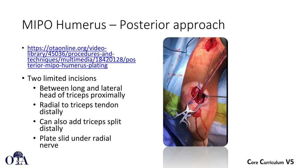 mipo humerus posterior approach
