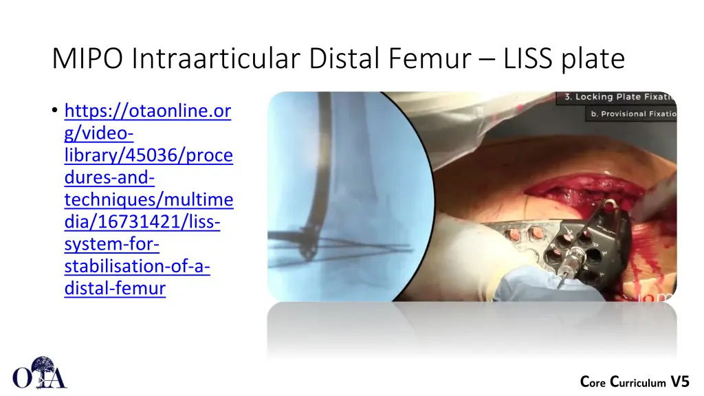 mipo intraarticular distal femur liss plate