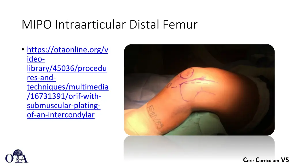 mipo intraarticular distal femur