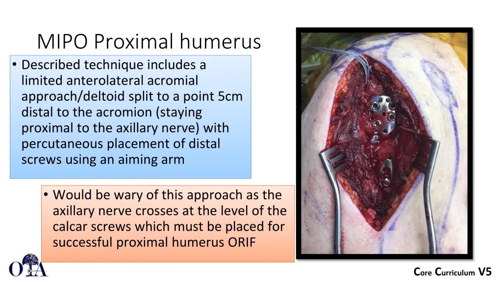 mipo proximal humerus described technique
