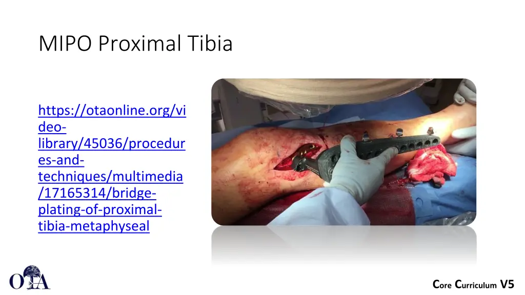 mipo proximal tibia