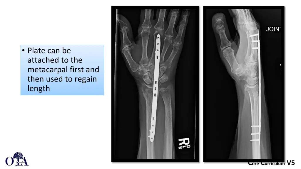 plate can be attached to the metacarpal first