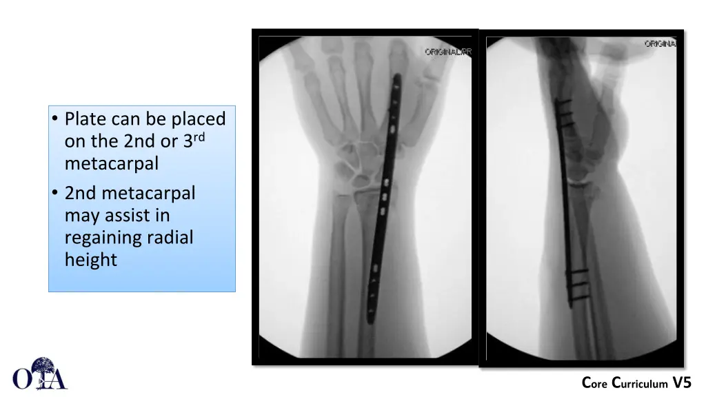 plate can be placed on the 2nd or 3 rd metacarpal