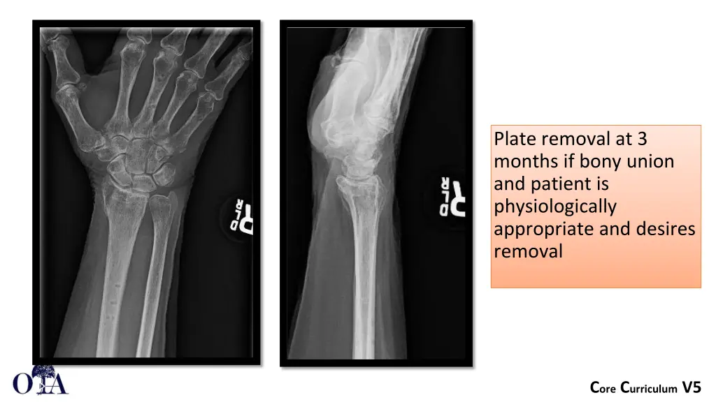 plate removal at 3 months if bony union