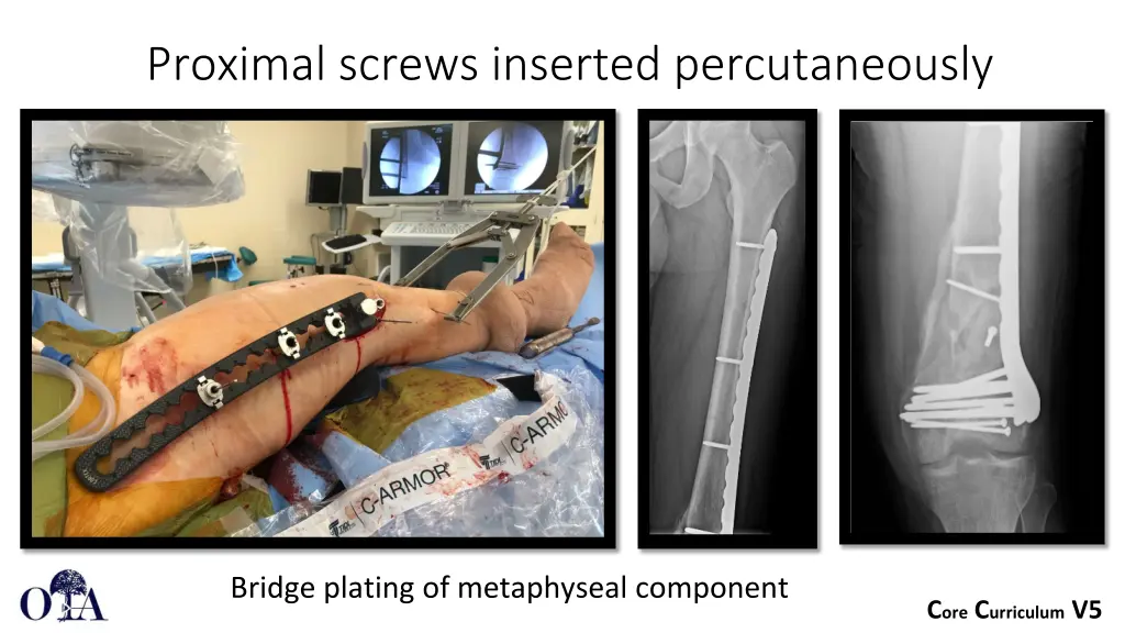 proximal screws inserted percutaneously