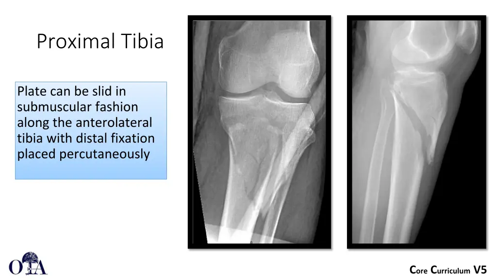 proximal tibia