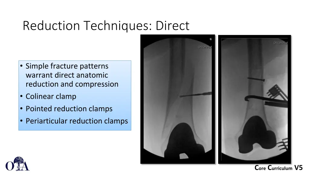 reduction techniques direct