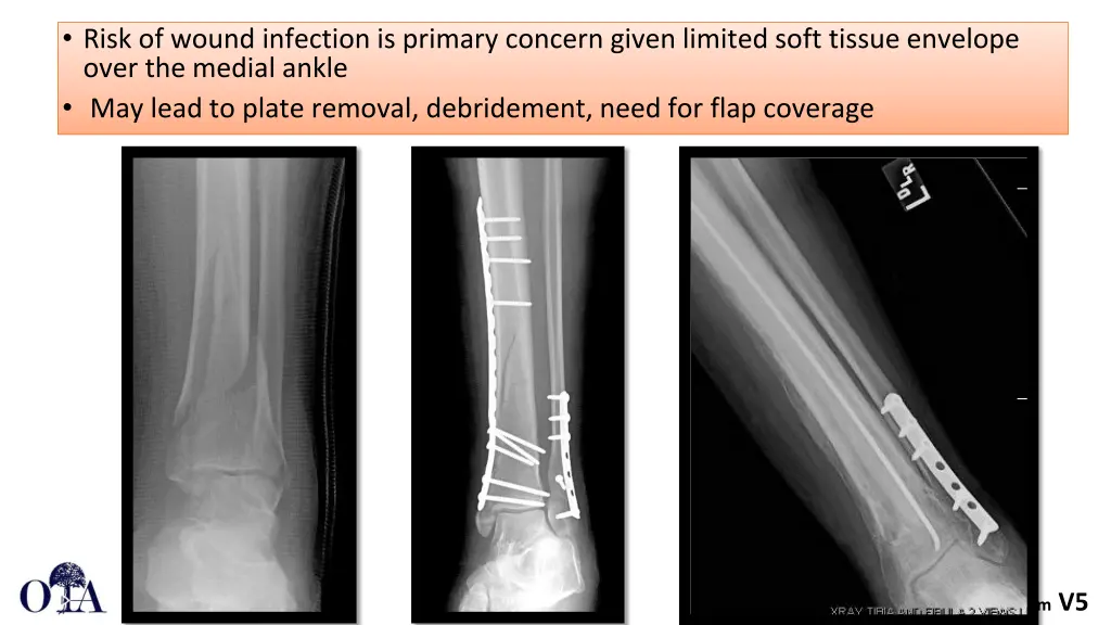 risk of wound infection is primary concern given