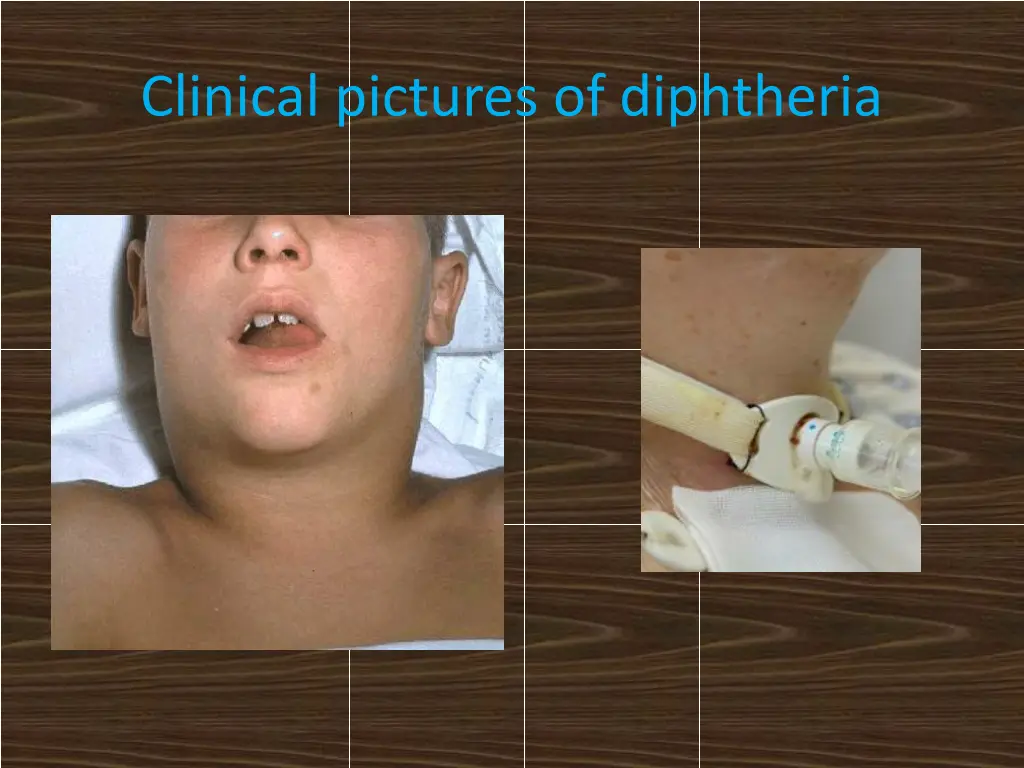 clinical pictures of diphtheria 1
