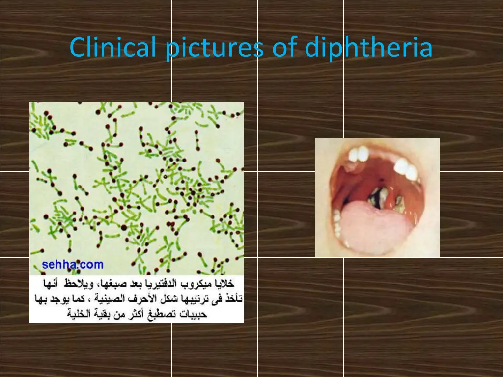 clinical pictures of diphtheria