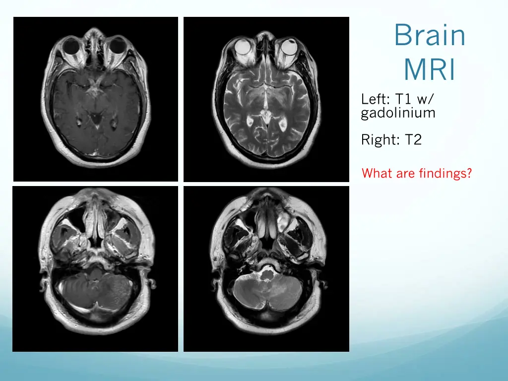 brain mri left t1 w gadolinium