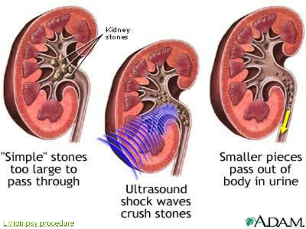 lithotripsy procedure