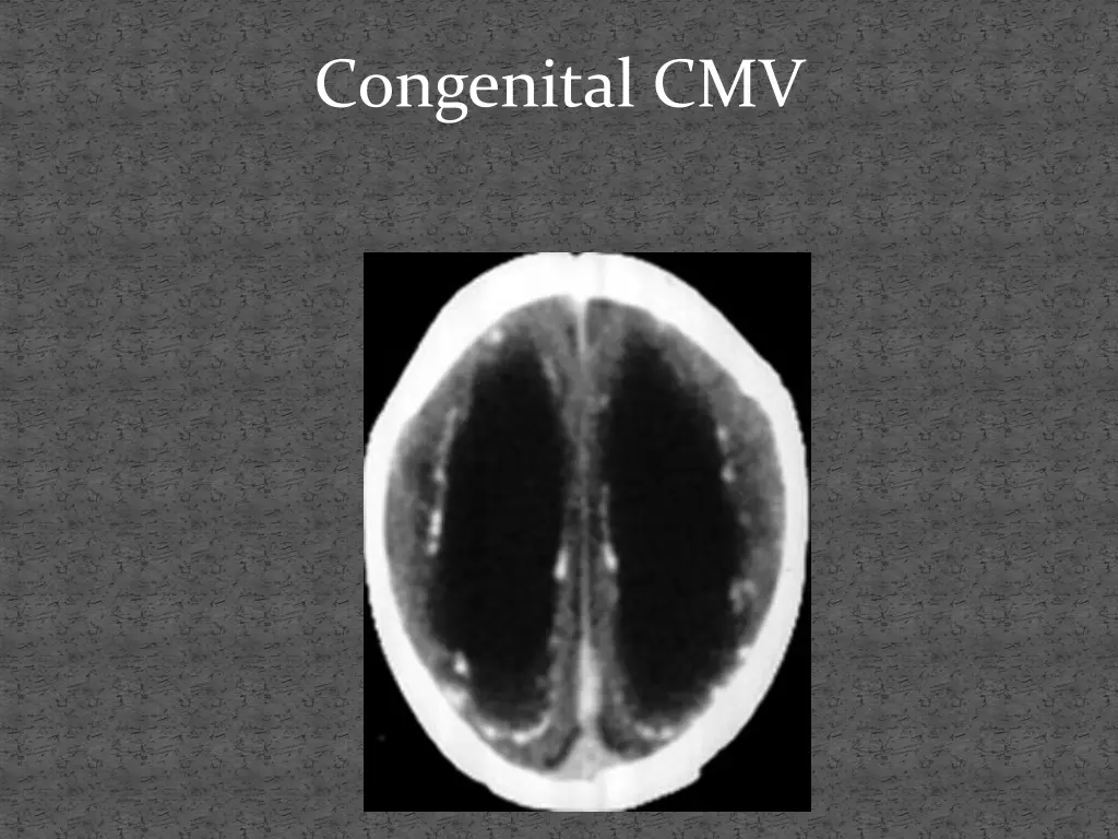 congenital cmv