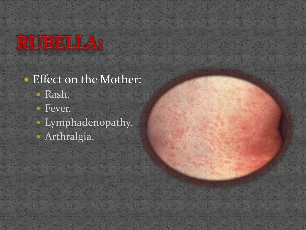effect on the mother rash fever lymphadenopathy
