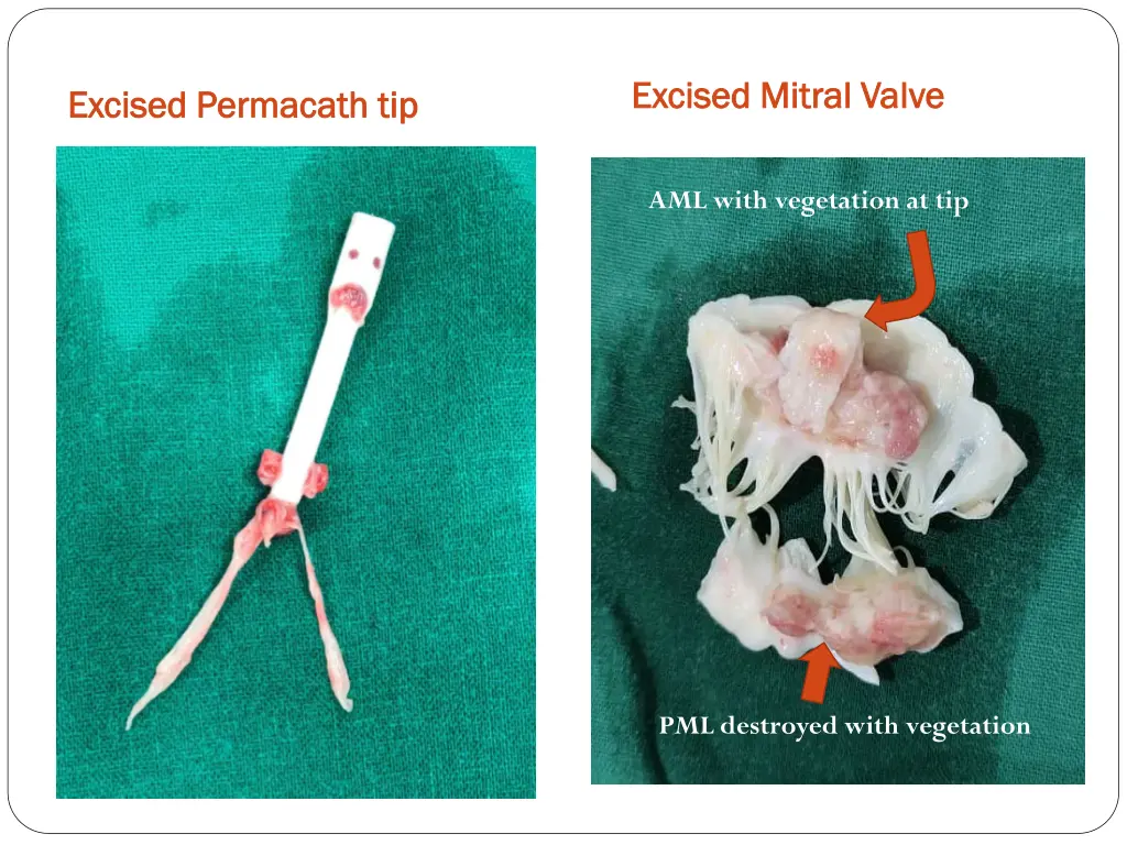 excised mitral valve excised mitral valve