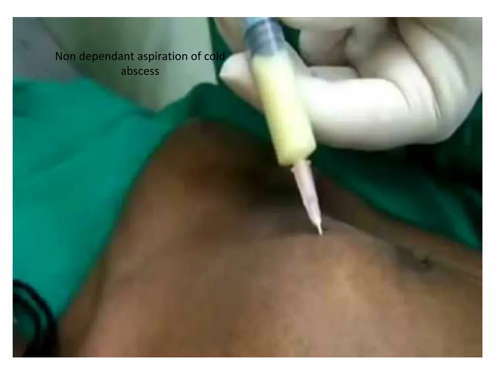 non dependant aspiration of cold abscess