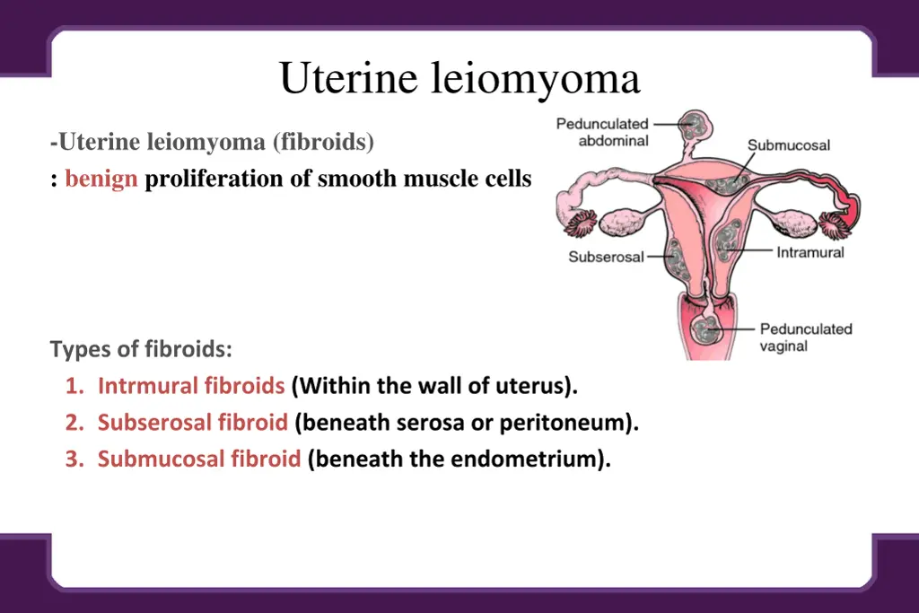 uterine leiomyoma