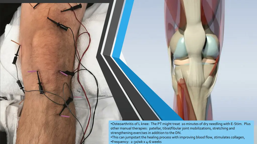 osteoarthritis of l knee the pt might treat