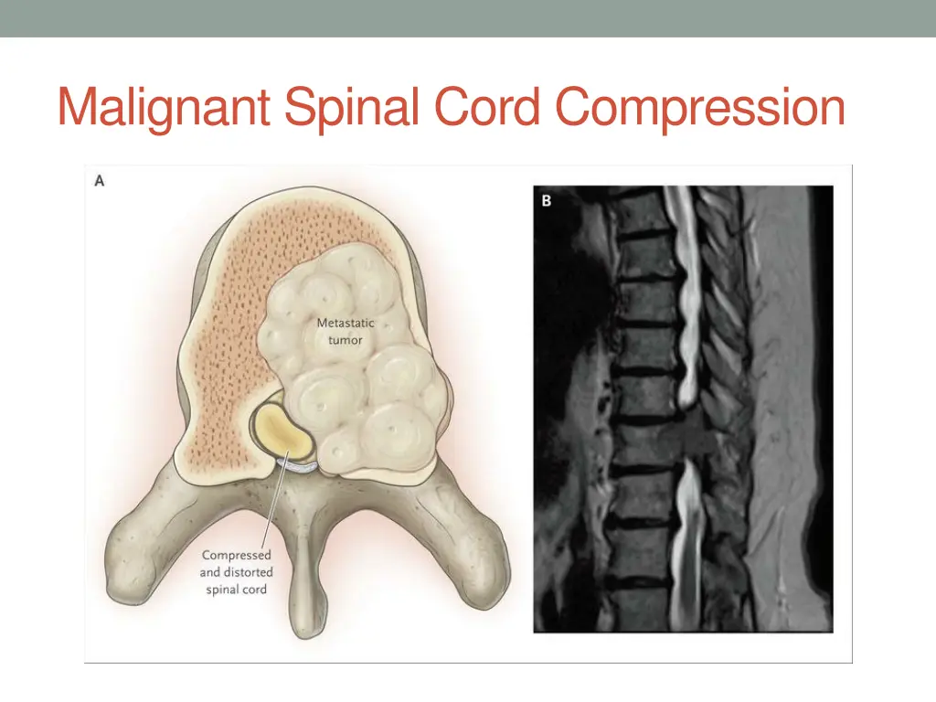 malignant spinal cord compression