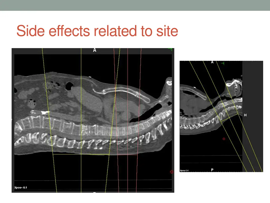 side effects related to site