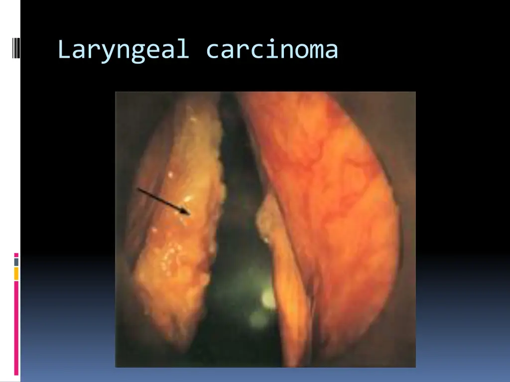 laryngeal carcinoma