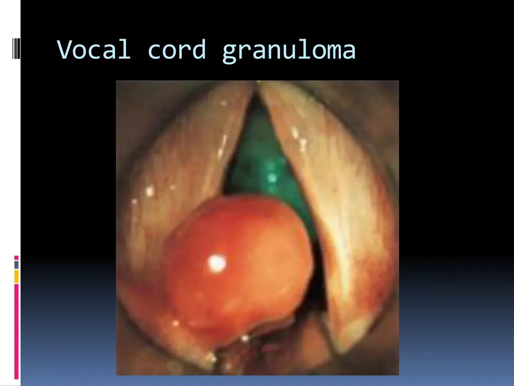 vocal cord granuloma