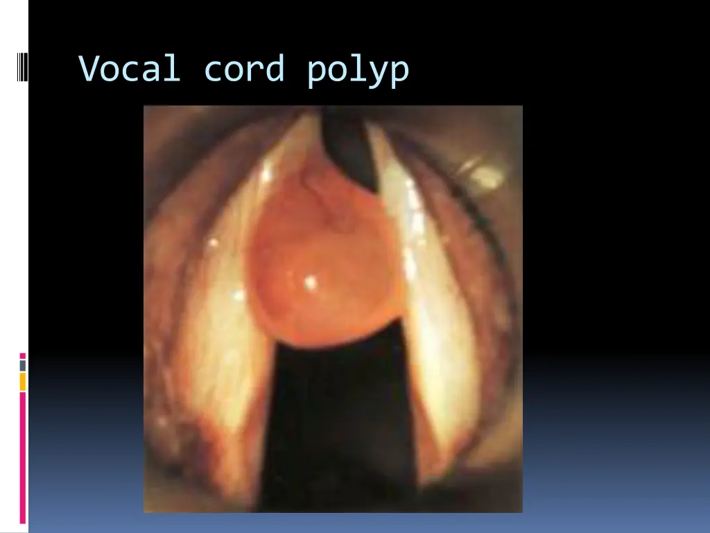vocal cord polyp
