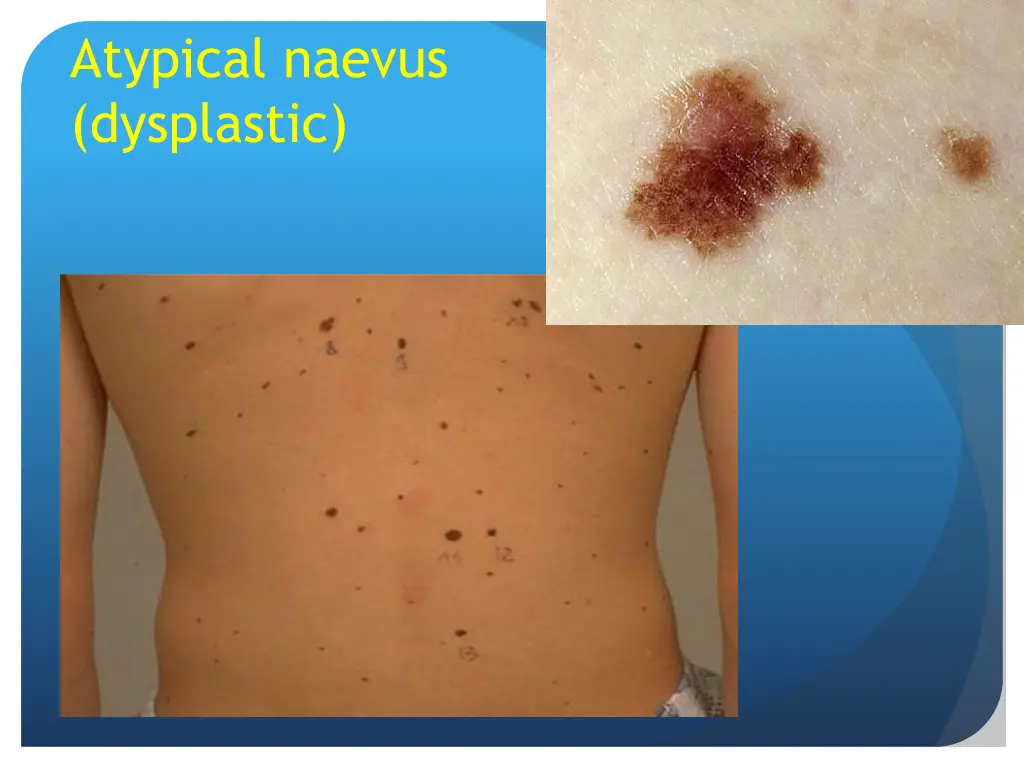 atypical naevus dysplastic